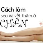 Mẹo trị sẹo thâm ở chân lâu năm hiệu quả