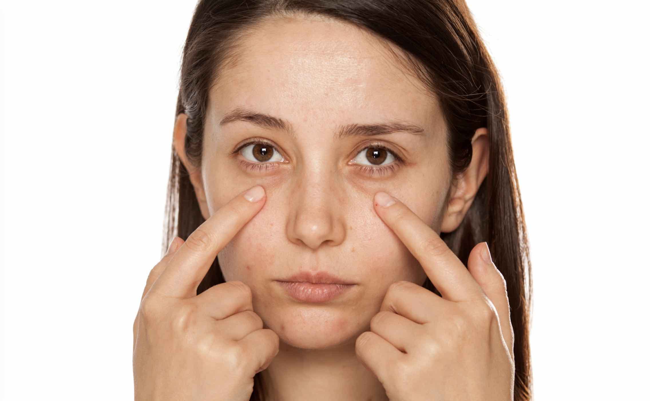 Hiệu quả trước và sau khi sử dụng kem trị thâm quầng mắt Emco