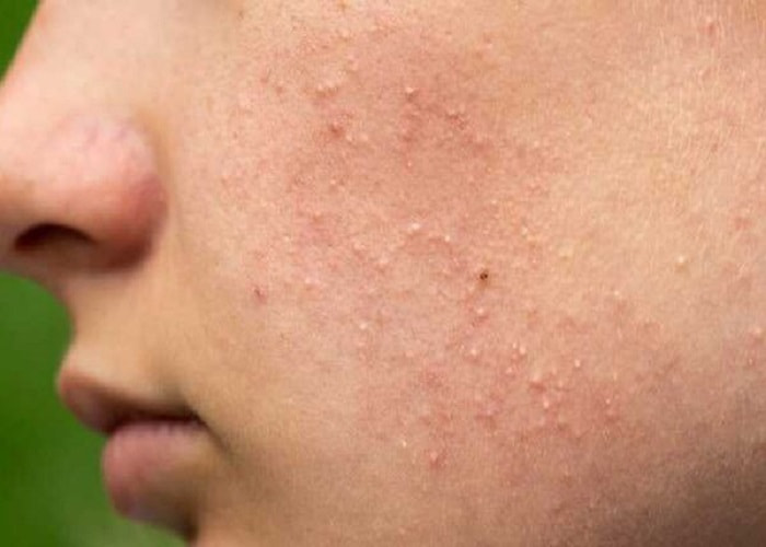 Gel giảm mụn ACTIDEM DERMA
