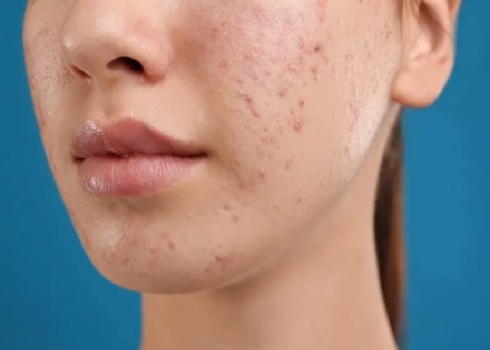 Gel giảm mụn ACTIDEM DERMA EXTRA